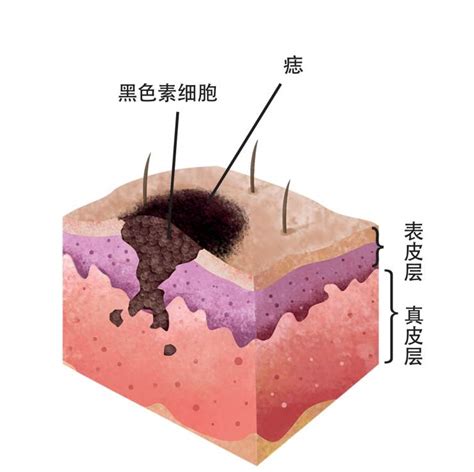 痣的形成